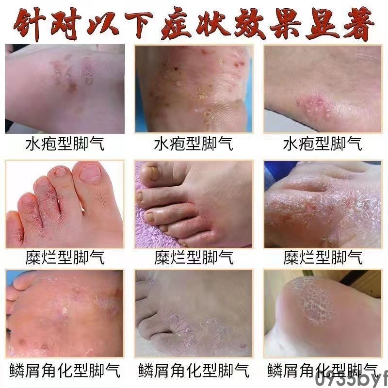 脚气不痒可是脱皮怎样回事-有来大夫