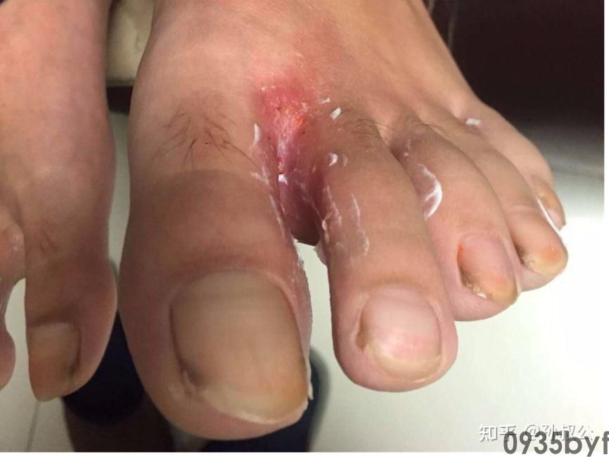 脚气的症状如何治都有哪些