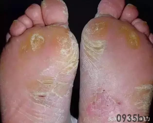 脚气症状