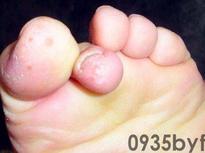 脚气病有什么症状怎么治脚气(图1) 脚气病有什么症状怎么治脚气