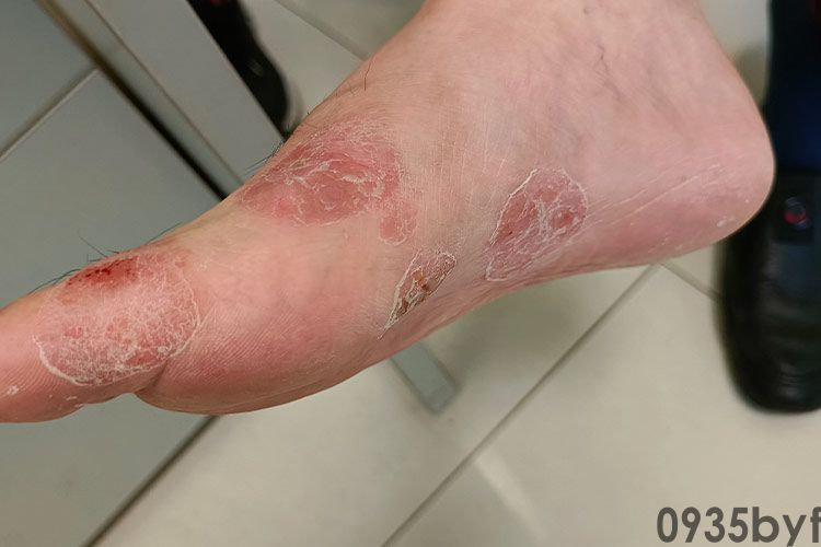 得脚气的症状有哪些