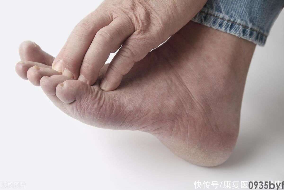 鳞屑角化型足癣脚底干燥增厚图-有来医生