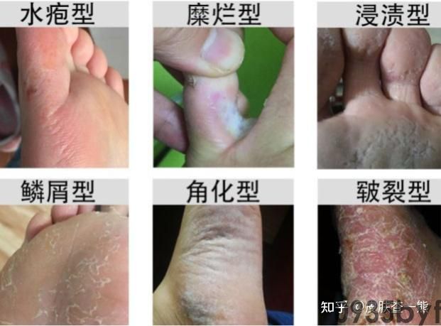 糜烂型脚气的原因是哪些