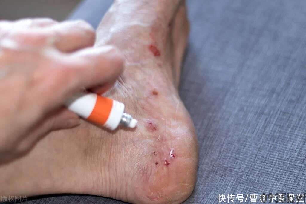 红斑水泡-有来医生