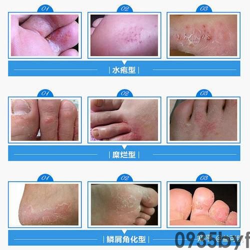 怎么治糜烂性脚气