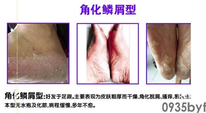 鳞屑角化型脚气用啥药