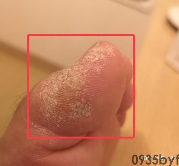 鳞屑皮肤病是怎么引起的