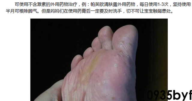 鳞屑角化型足癣脚底板多处脱皮图-有来医生