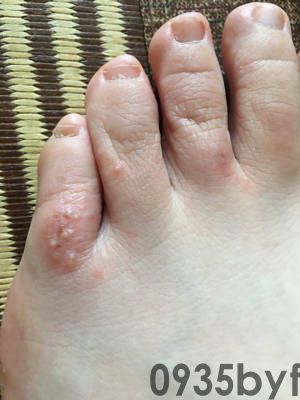 什么治脚气脚臭效果好(图1) 什么治脚气脚臭效果好