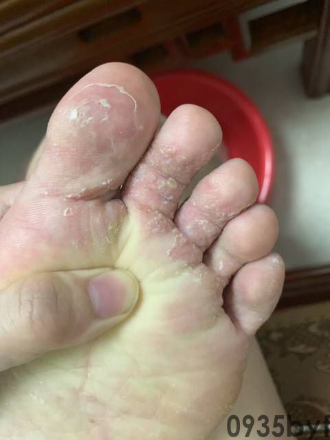 脚气臭脚怎么治疗(图1) 脚气臭脚怎么治疗