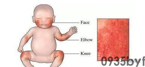 异位性皮炎是怎样的一种疾病