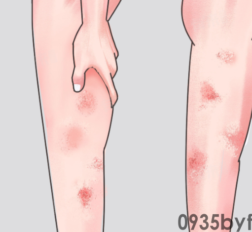 身上出现红斑不痛不痒(图1) 身上出现红斑不痛不痒(图1)