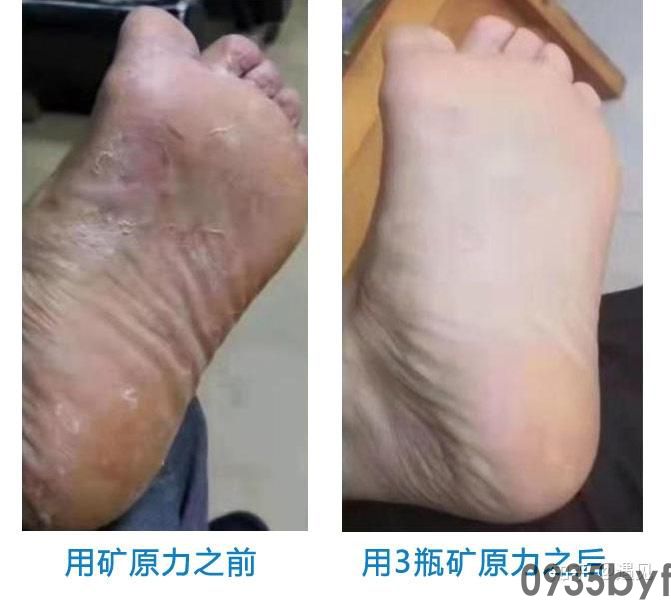 真菌克星来了！过来人分享自用脚气产品评测两周解决顽固脚气！