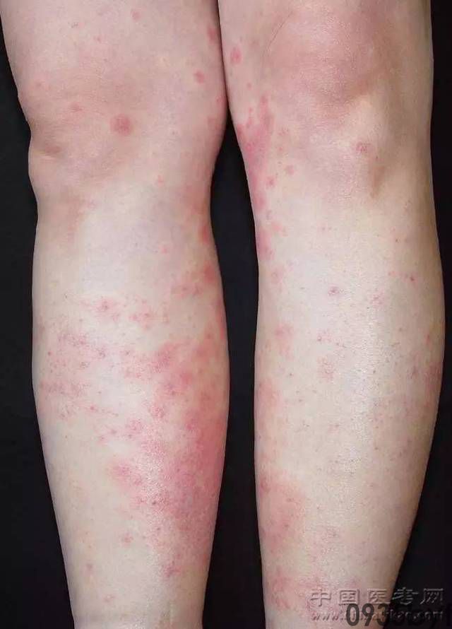 红斑样皮疹是什么样的皮肤病症(图1) 红斑样皮疹是什么样的皮肤病症