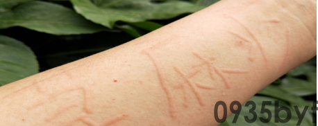 荨麻疹跟红斑狼疮的区别?(图1) 荨麻疹跟红斑狼疮的区别?