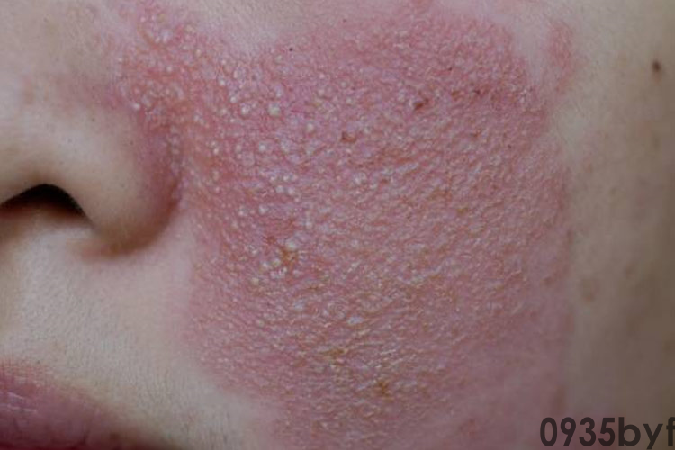 面部红斑皮炎图片(图1) 面部红斑皮炎图片(图1)