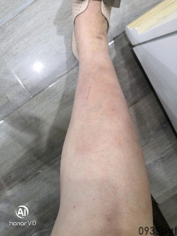 红斑狼疮普遍寿命