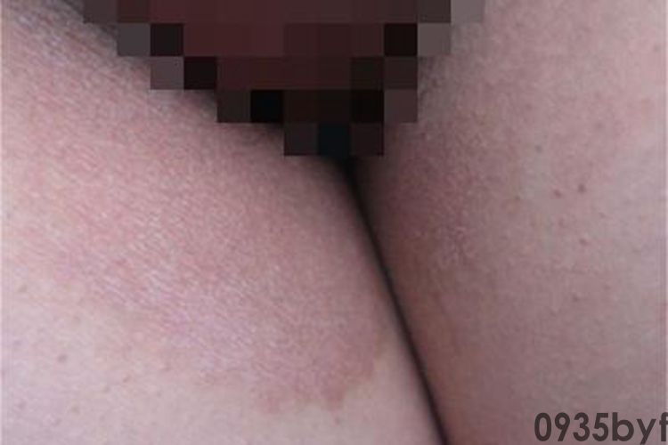 红癣斑图片_有来医生(图1)