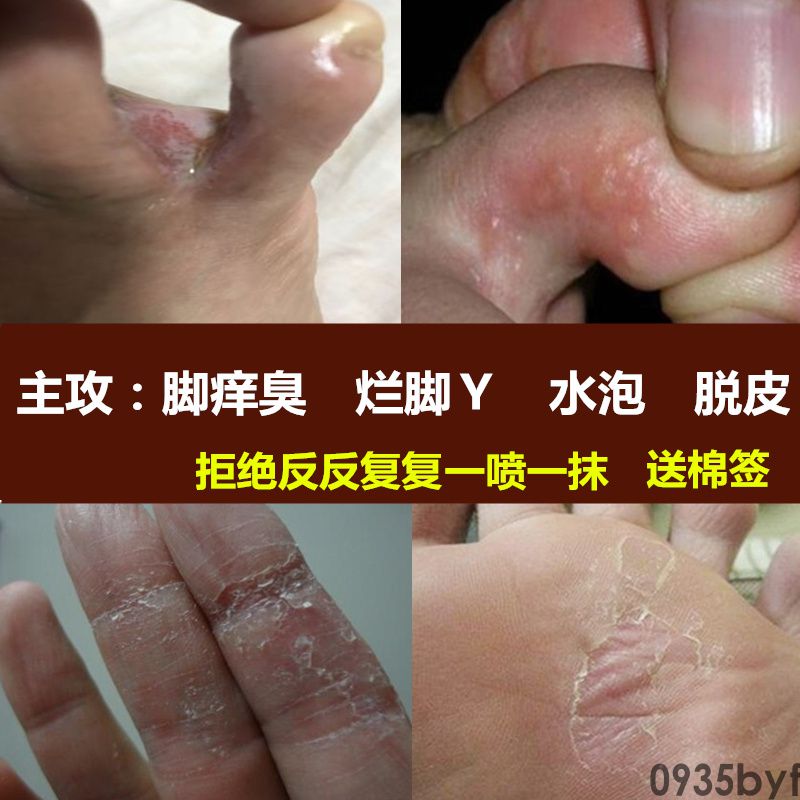水泡型脚气反复发作怎么办