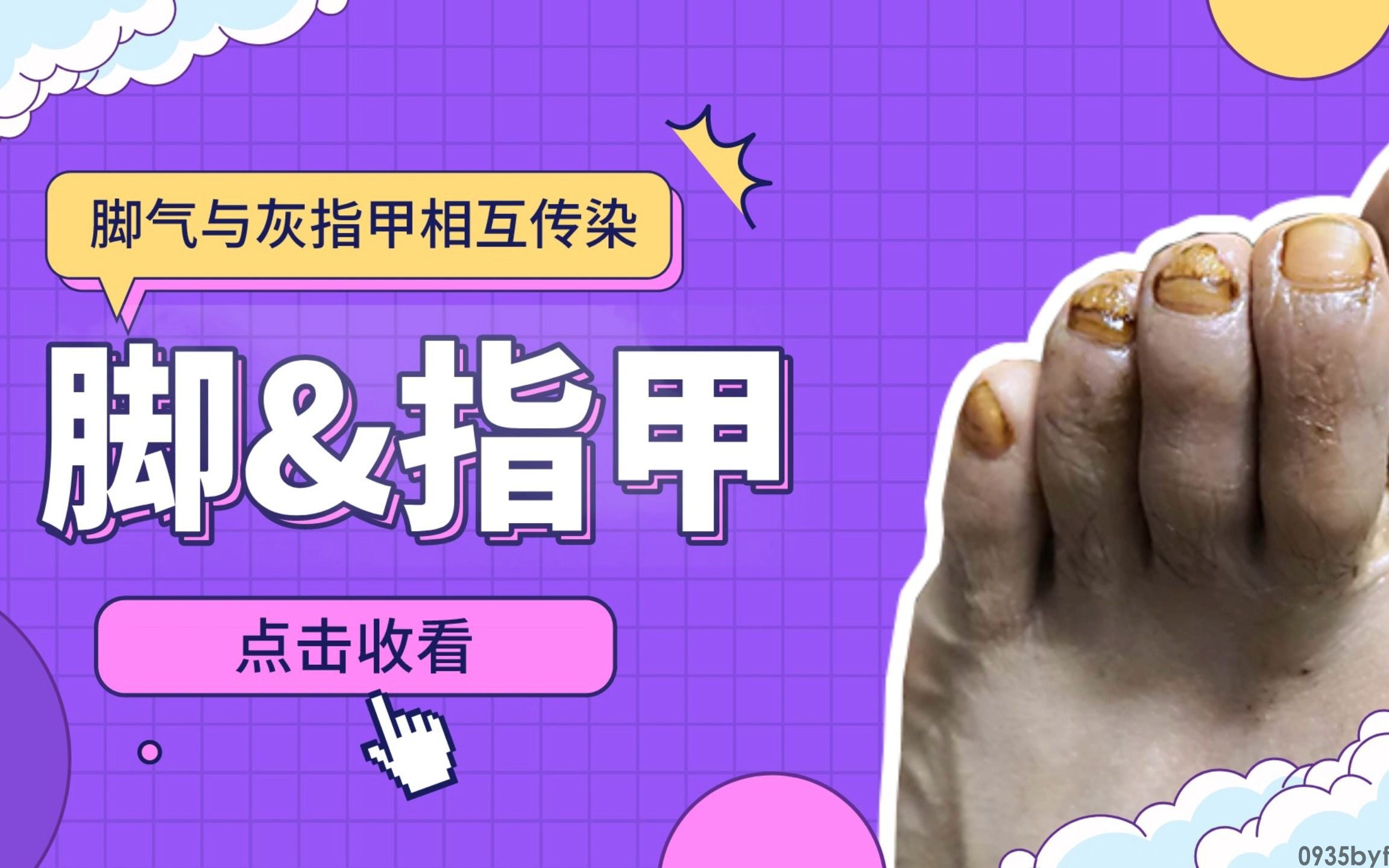 灰指甲和脚气的关系