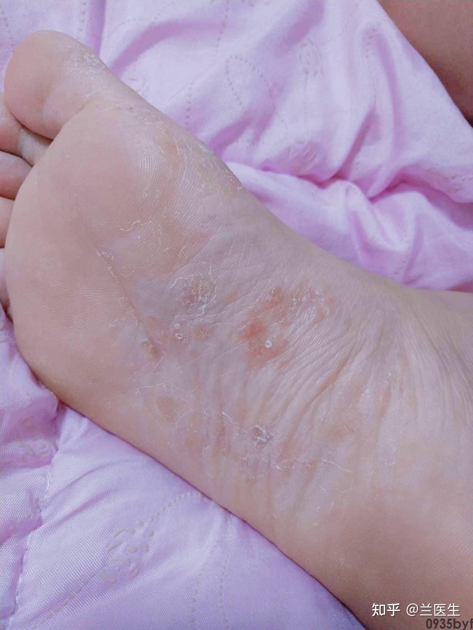 夏天脚长小水泡很痒怎么治