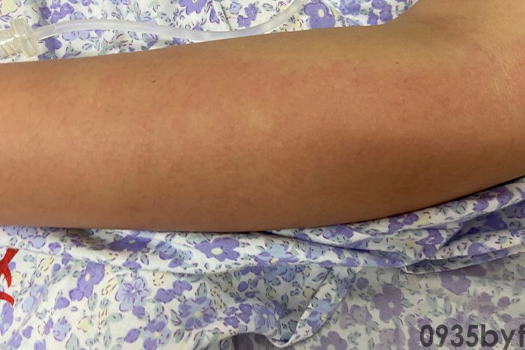 荨麻疹红斑图片(图5) 荨麻疹红斑图片(图5)