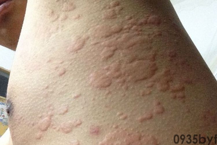 荨麻疹红斑图片(图4) 荨麻疹红斑图片(图4)