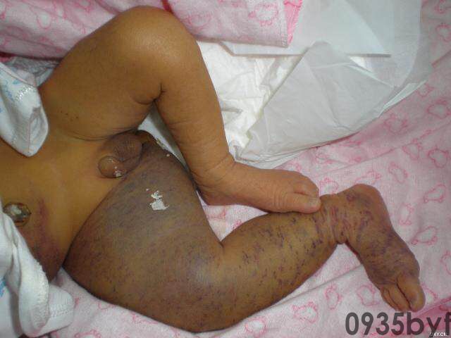 常见皮肤疾病典型图片汇总(图4)