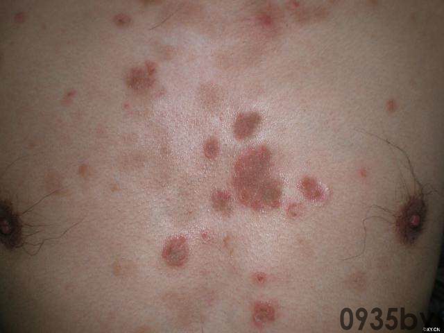 常见皮肤疾病典型图片汇总(图8)