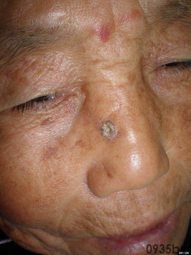 常见皮肤疾病典型图片汇总(图17)