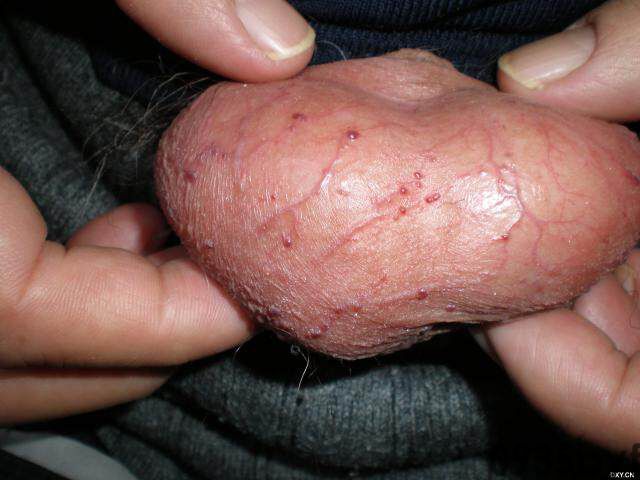 常见皮肤疾病典型图片汇总(图13)