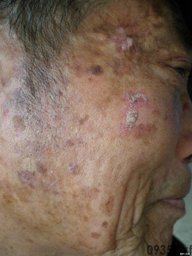 常见皮肤疾病典型图片汇总(图18)
