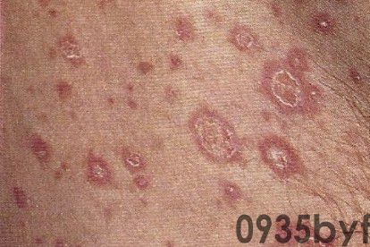 红斑是什么症状图片怎么治(图3)