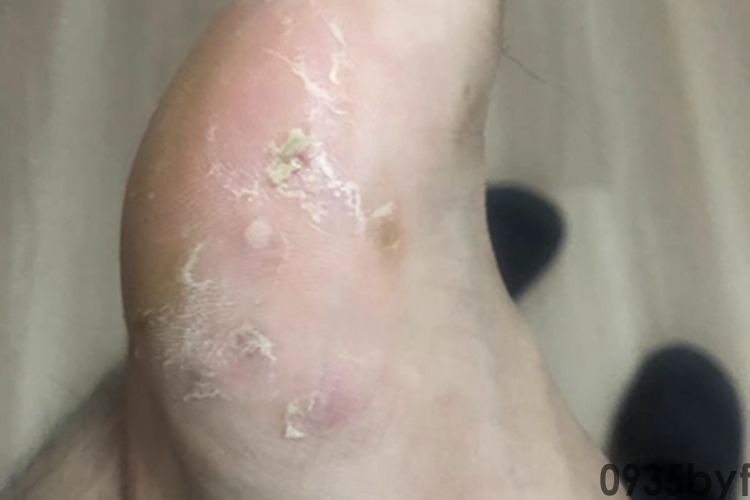 足癣脚部脱皮图片(图3)