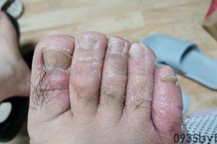 糜烂型足癣脚趾症状图片(图2)