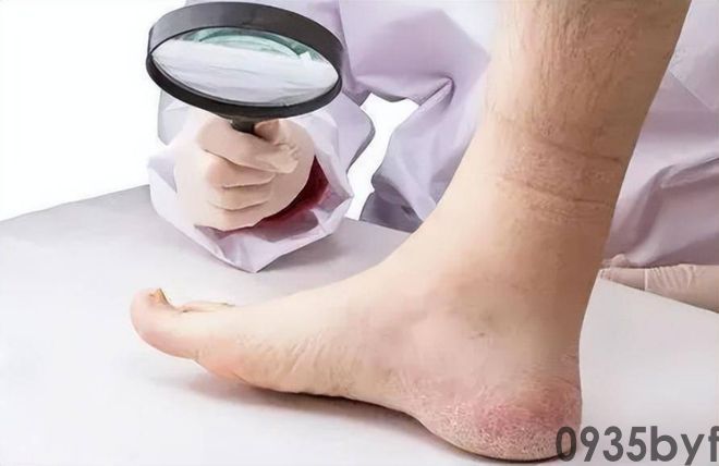 我国脚气患者上亿人这些东西才脚气的“祸根”！(图2)