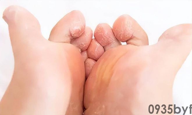 我国脚气患者上亿人这些东西才脚气的“祸根”！(图6)