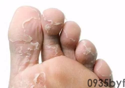 脚气初期症状是什么样的?(图2) 脚气初期症状是什么样的?(图2)