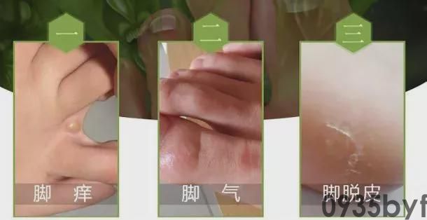 风行全欧洲的脚气水无色有趣20年香港脚也能救!(图3) 风行全欧洲的脚气水无色有趣20年香港脚也能救!(图3)