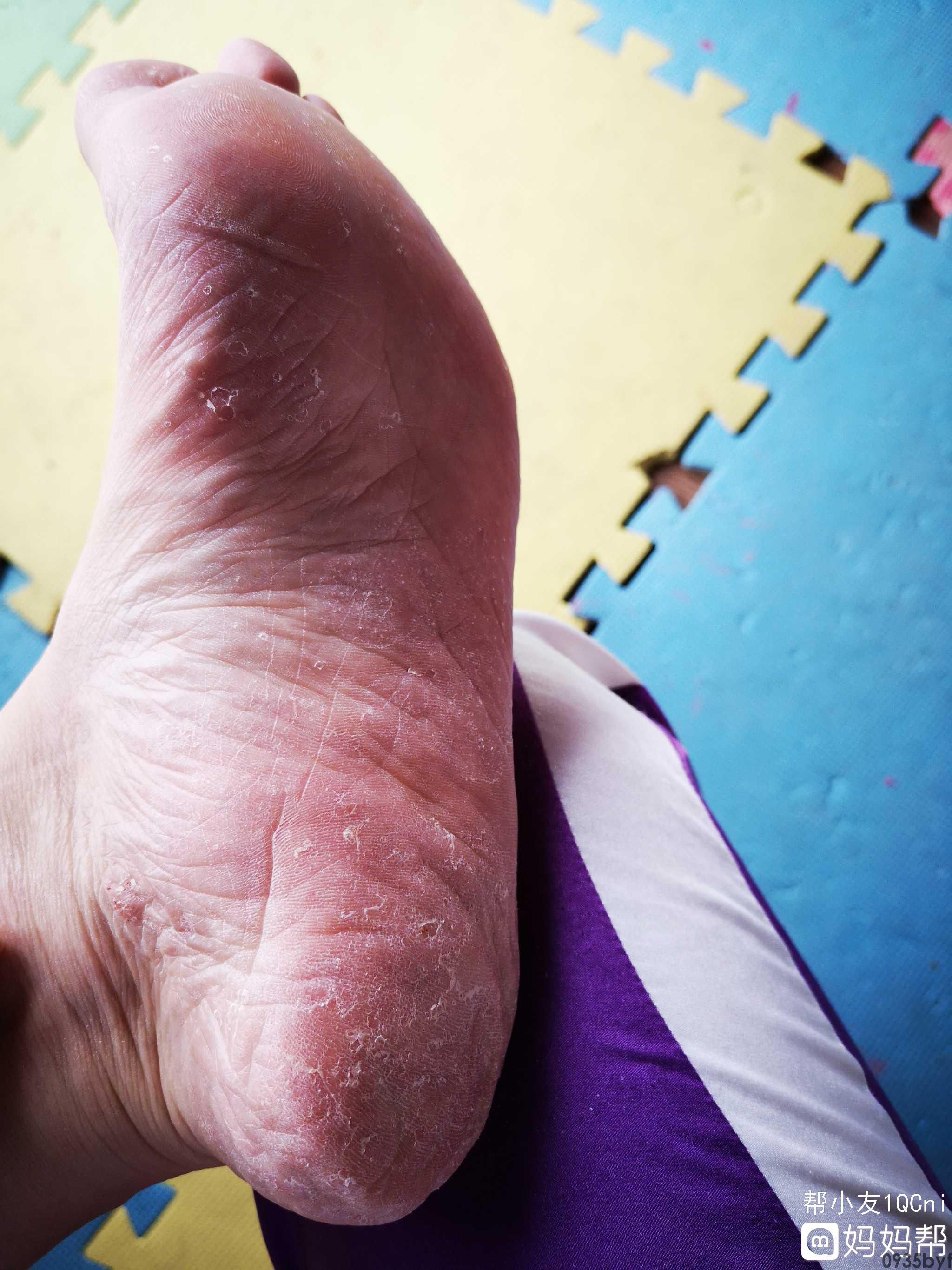 脚部腐败型脚气怎样医治