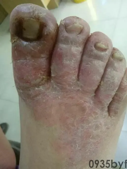 瘙痒型脚气如何根治？