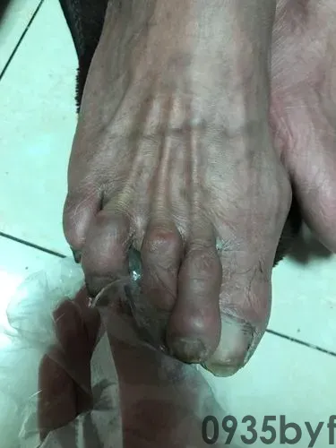 脚不痒不臭只脱皮是怎样回事