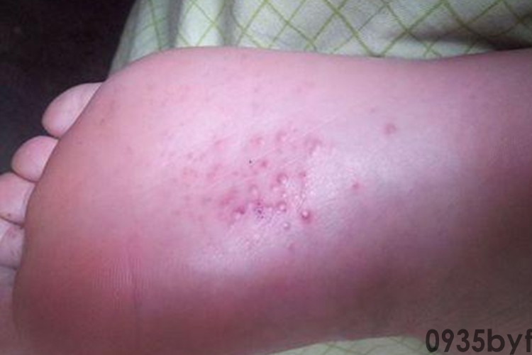 水疱型脚气图片(图1) 水疱型脚气图片(图1)