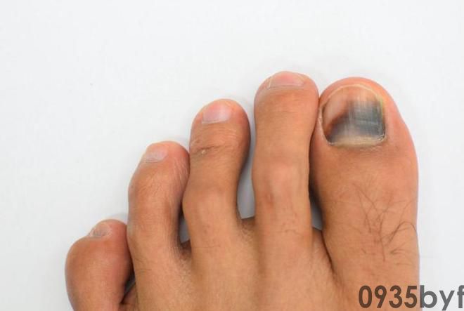 疾病来前脚先知？提示：快看看你的脚有这5个病症别无视！(图5)