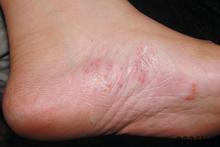 18种皮肤常见疾病结合用药超适用