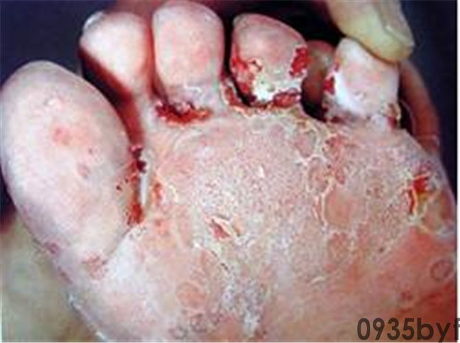 把擦脚巾当洗脸巾竟招致“脚气”上脸宁波27岁帅小伙惨绝人寰！大夫：一人传染可感染百口！许多人没当回事