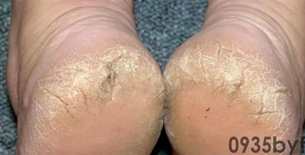 脚后跟总开裂起皮 没必要然是枯燥酿成的！当心这几种病(图2)