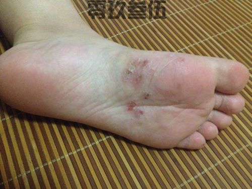 有脚气的床单怎样洗