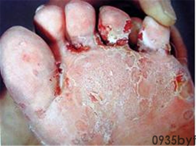 湿疹和脚气有什么区分