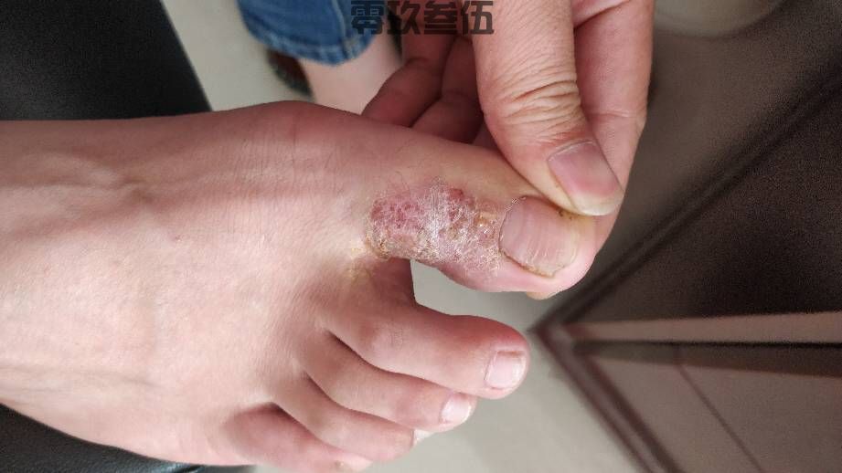 脚气用什么药？